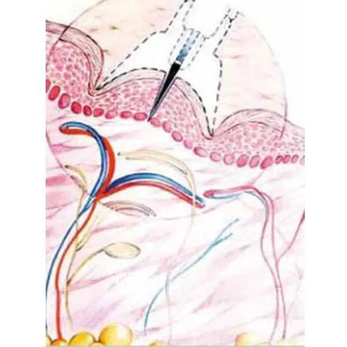 Dispozitiv Meso-relle pentru micro-mezoterapie (terapia cu injectie cutanata)