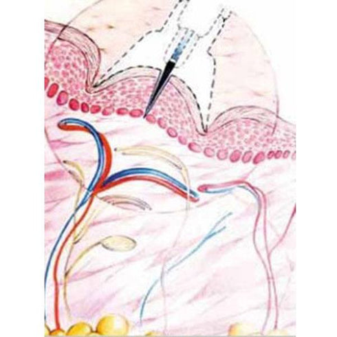 Dispozitiv Meso-relle pentru micro-mezoterapie (terapia cu injectie cutanata) 2